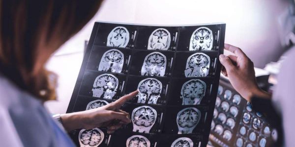 Τι αλλαγές στον εγκέφαλο μπορεί να επιφέρει ακόμη και η ήπια Covid-19 - Ειδήσεις Pancreta