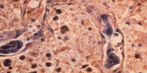 Ελπιδοφόρα ανακάλυψη: Εντοπίστηκε κύτταρο που «ενδέχεται να θεραπεύει όλους τους καρκίνoυς» - Ειδήσεις Pancreta