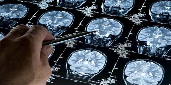 Σπουδαία ανακάλυψη για το Αλτσχάιμερ: Βρέθηκε εξέταση αίματος για τη διάγνωση της νόσου - Ειδήσεις Pancreta